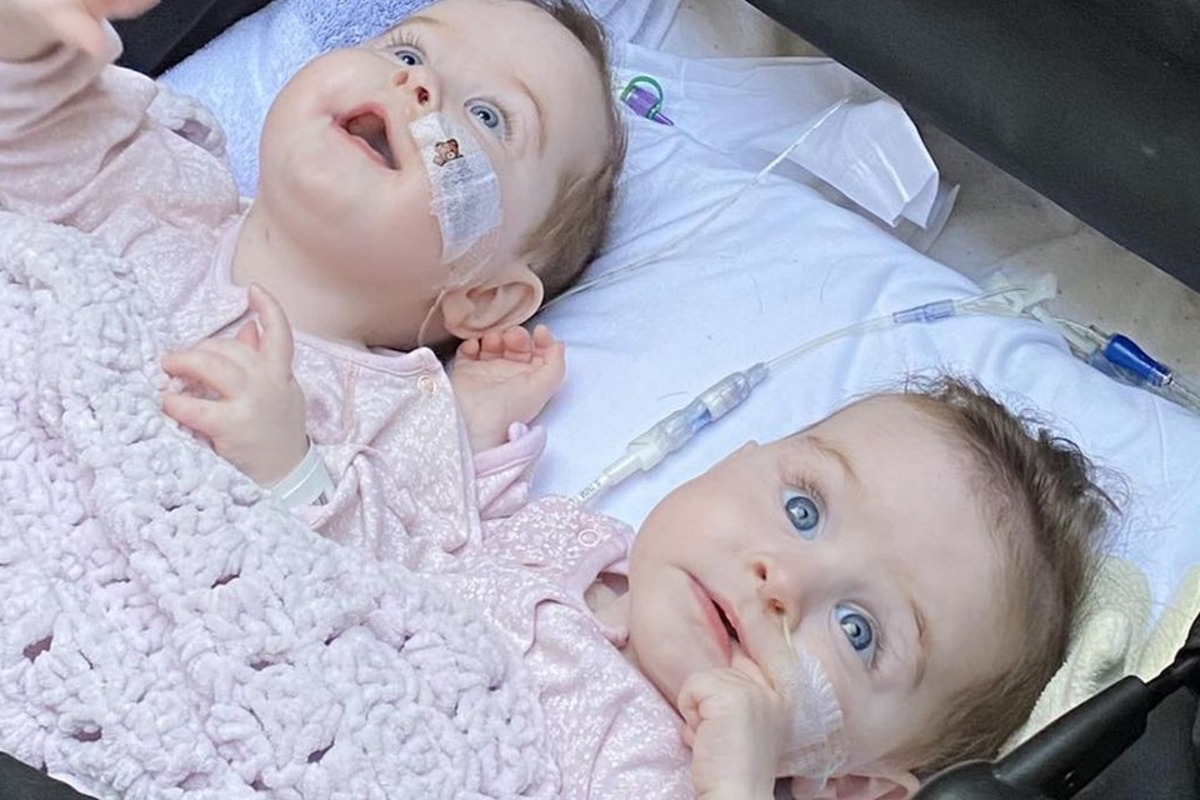 The Shocking Fate Of Conjoined Twins When One Passes Away