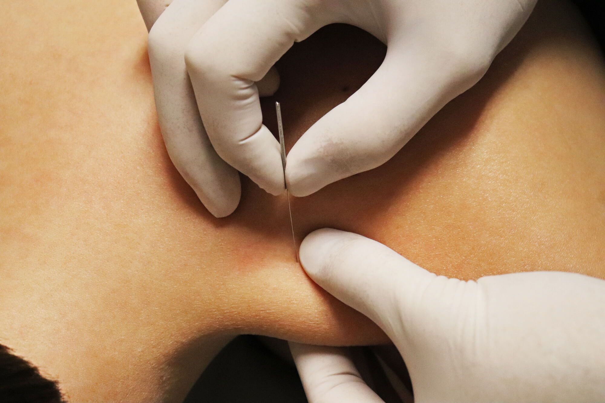 The Surprising Similarities And Differences Between Dry Needling And Acupuncture