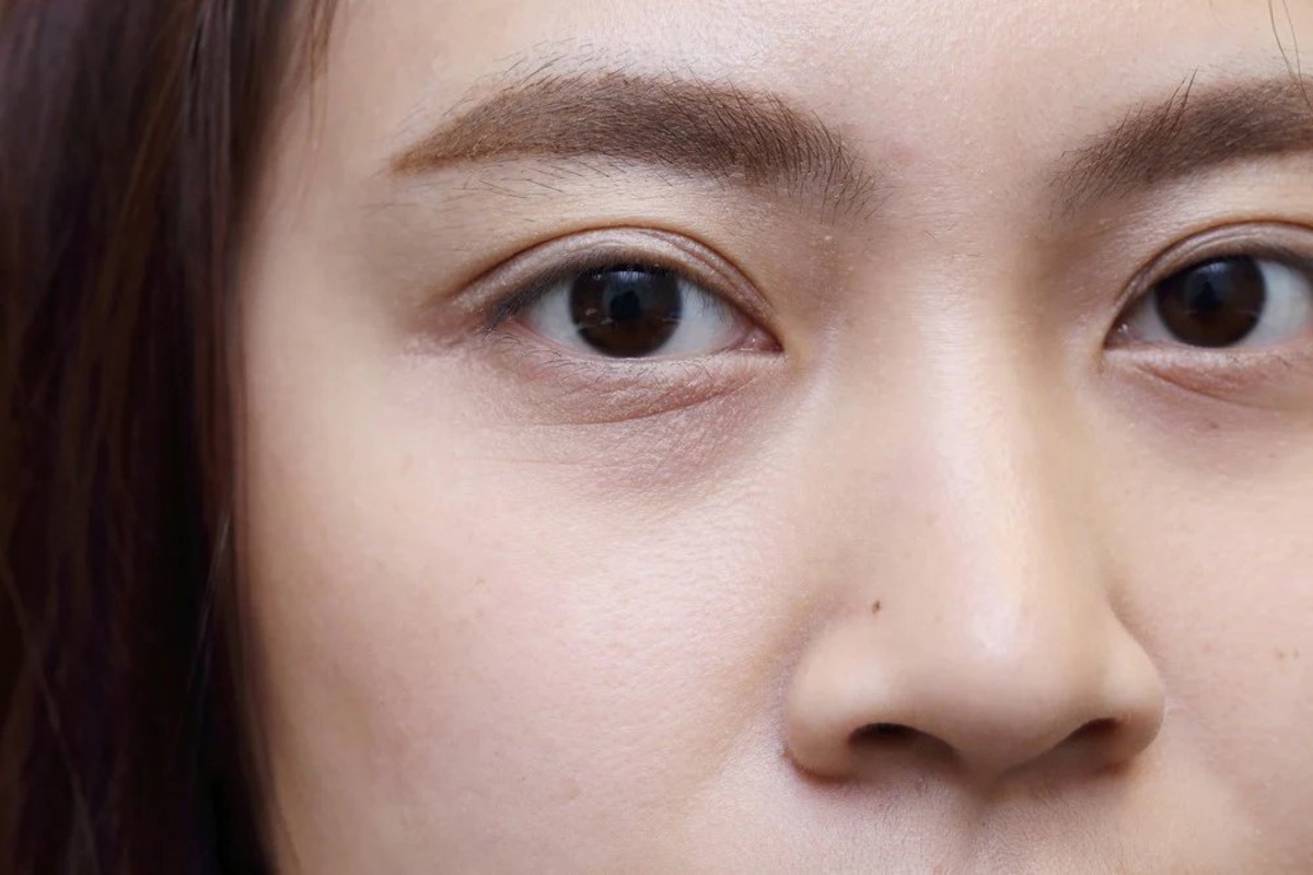 The Truth About Panda Eyes: Causes And Solutions Revealed!