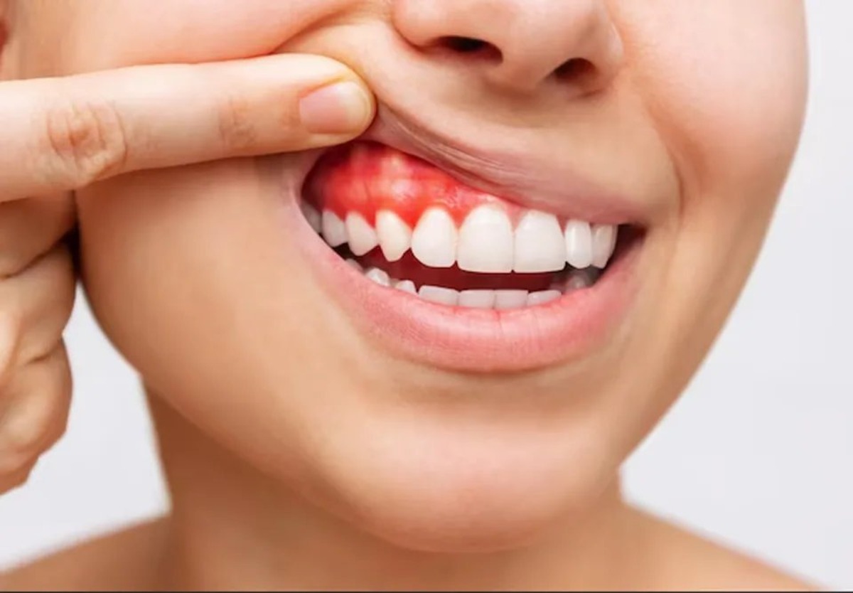 The Ultimate Guide To Healing Receding Gums