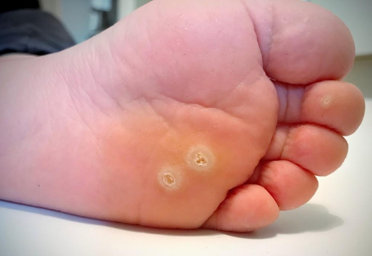 Unbelievable Transformation: Watch The Astonishing Disappearance Of A Plantar Wart Crater