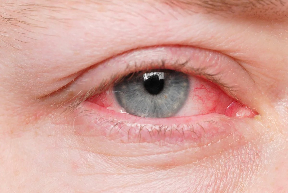 Unexpected Eye Irritation: Surprising Cause Revealed!