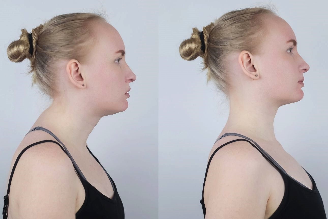 How To Get Rid Of Neck Hump