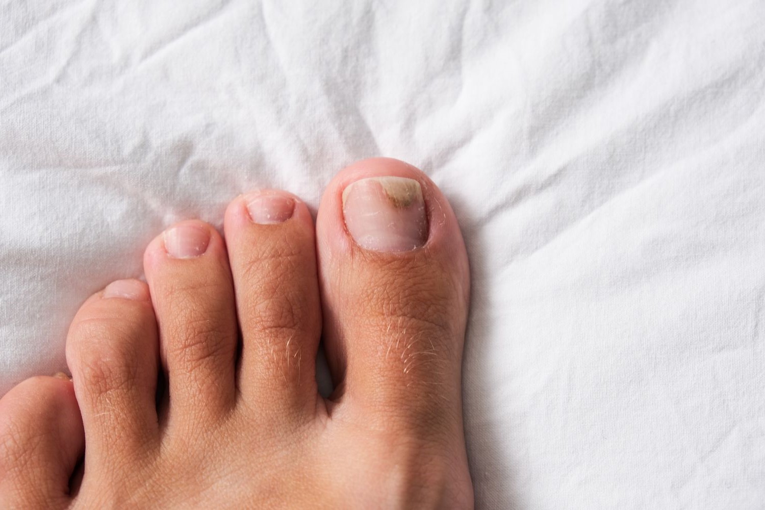 How To Know If Toenail Fungus Is Dying 1708825075 