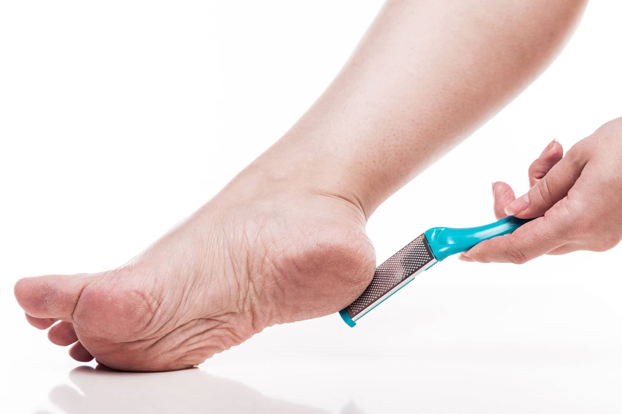 Say Goodbye To Foot Calluses With The Ultimate DIY Remover!