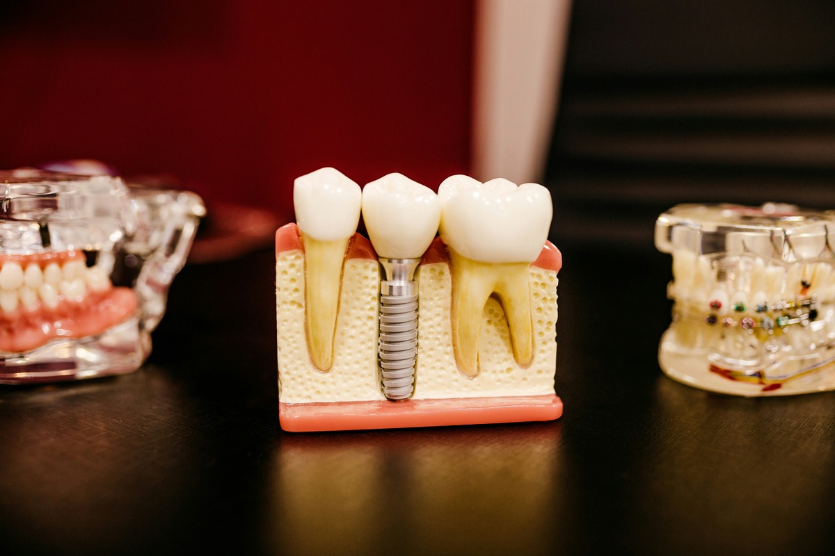 Unveiling The Shocking Price Tag Of A Single-Tooth Implant In The USA!